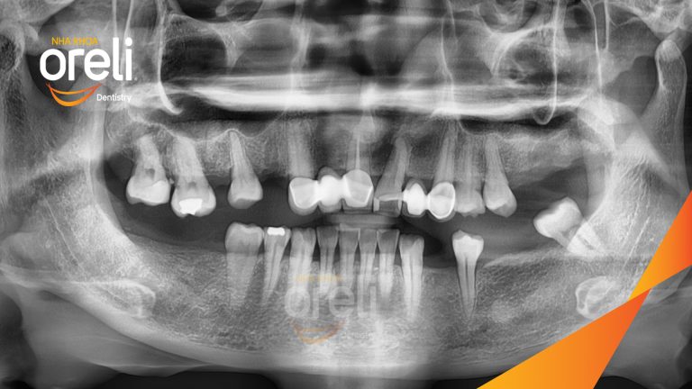 Ca Cấy Ghép Implant Hàm Dưới – Case thực tế tại Oreli