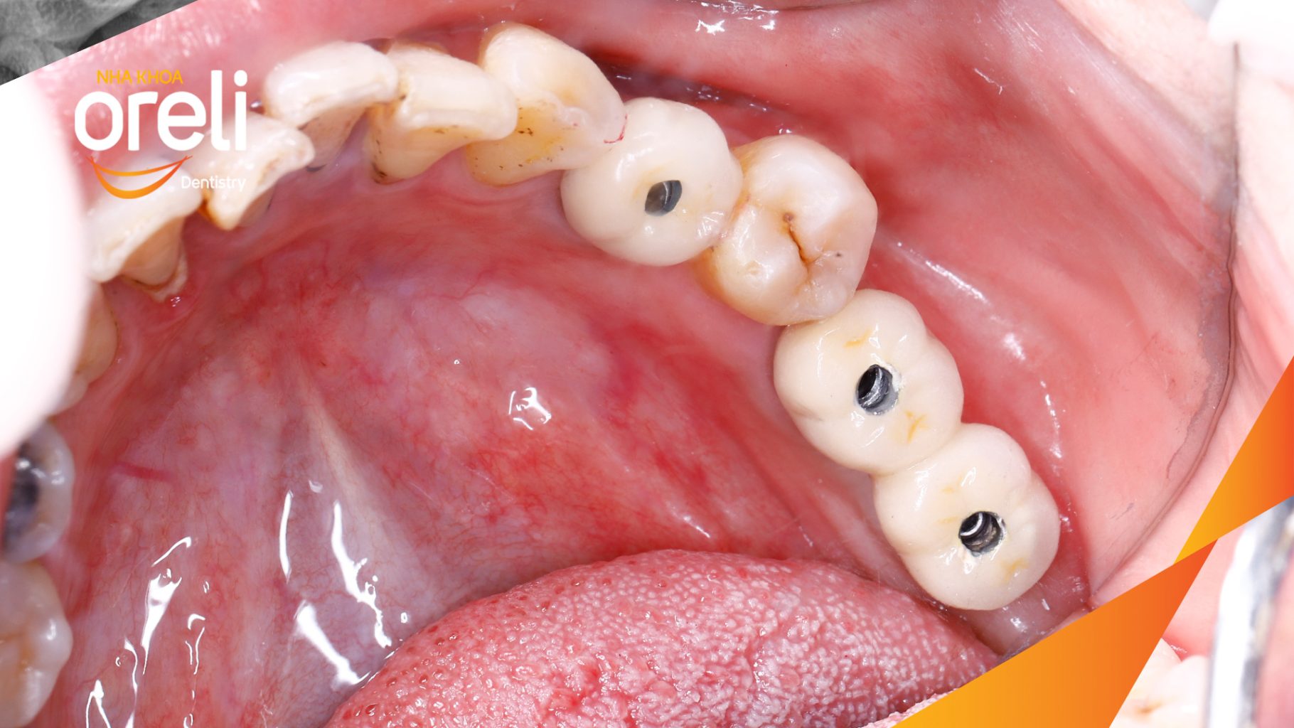 Kết quả sau 3 tháng: Phục hồi răng mất - ăn nhai chắc chắn và cười nói tự tin tại Oreli