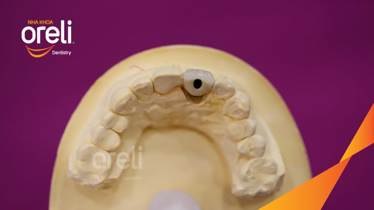 Ca Cấy Ghép Implant Hàm Dưới – Case thực tế tại Oreli