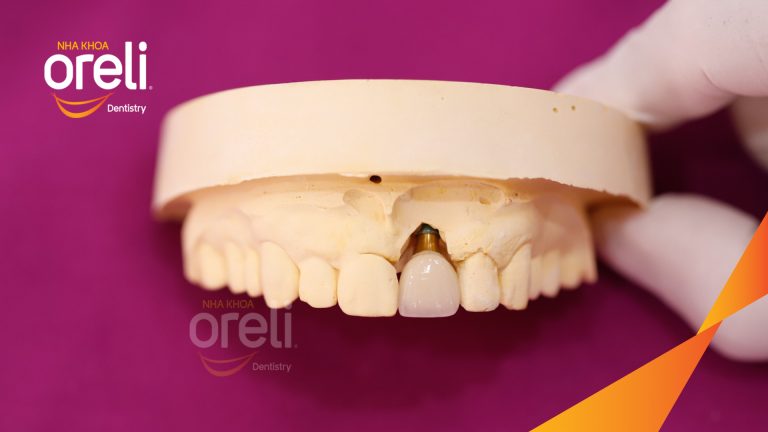 Ca Cấy Ghép Implant Hàm Dưới – Case thực tế tại Oreli