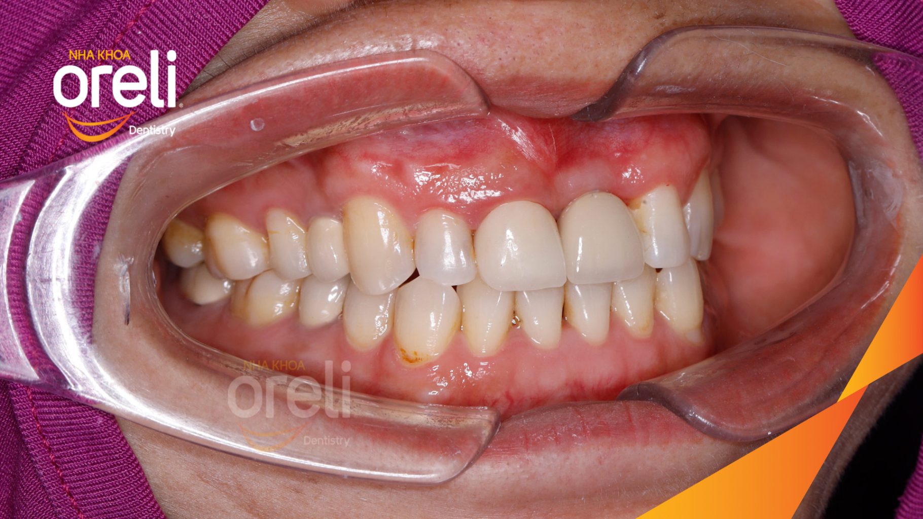 Kết quả sau 3 tháng: Phục hồi răng mất - ăn nhai chắc chắn và cười nói tự tin tại Oreli