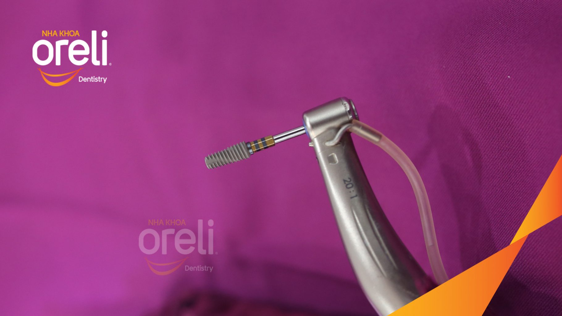 Kết quả đạt được sau 3 tháng - Phục hồi răng mất - ăn nhai chắc chắn và cười nói tự tin tại Oreli