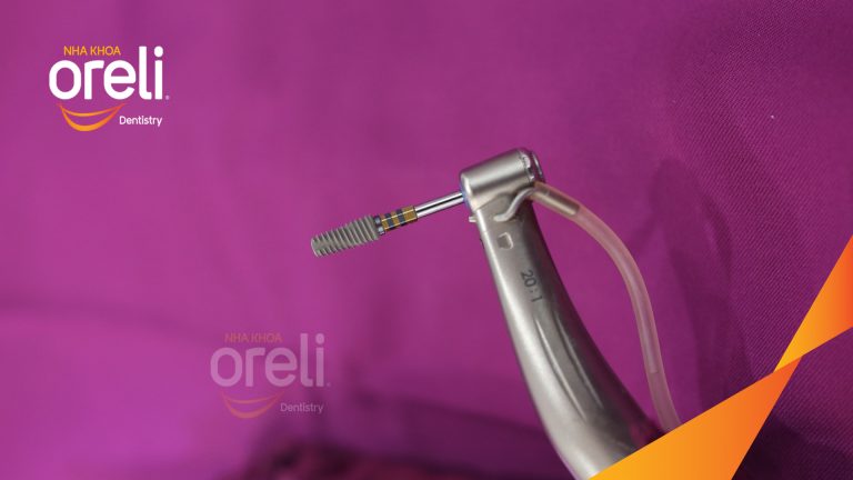 Ca Cấy Ghép Implant Hàm Dưới – Case thực tế tại Oreli