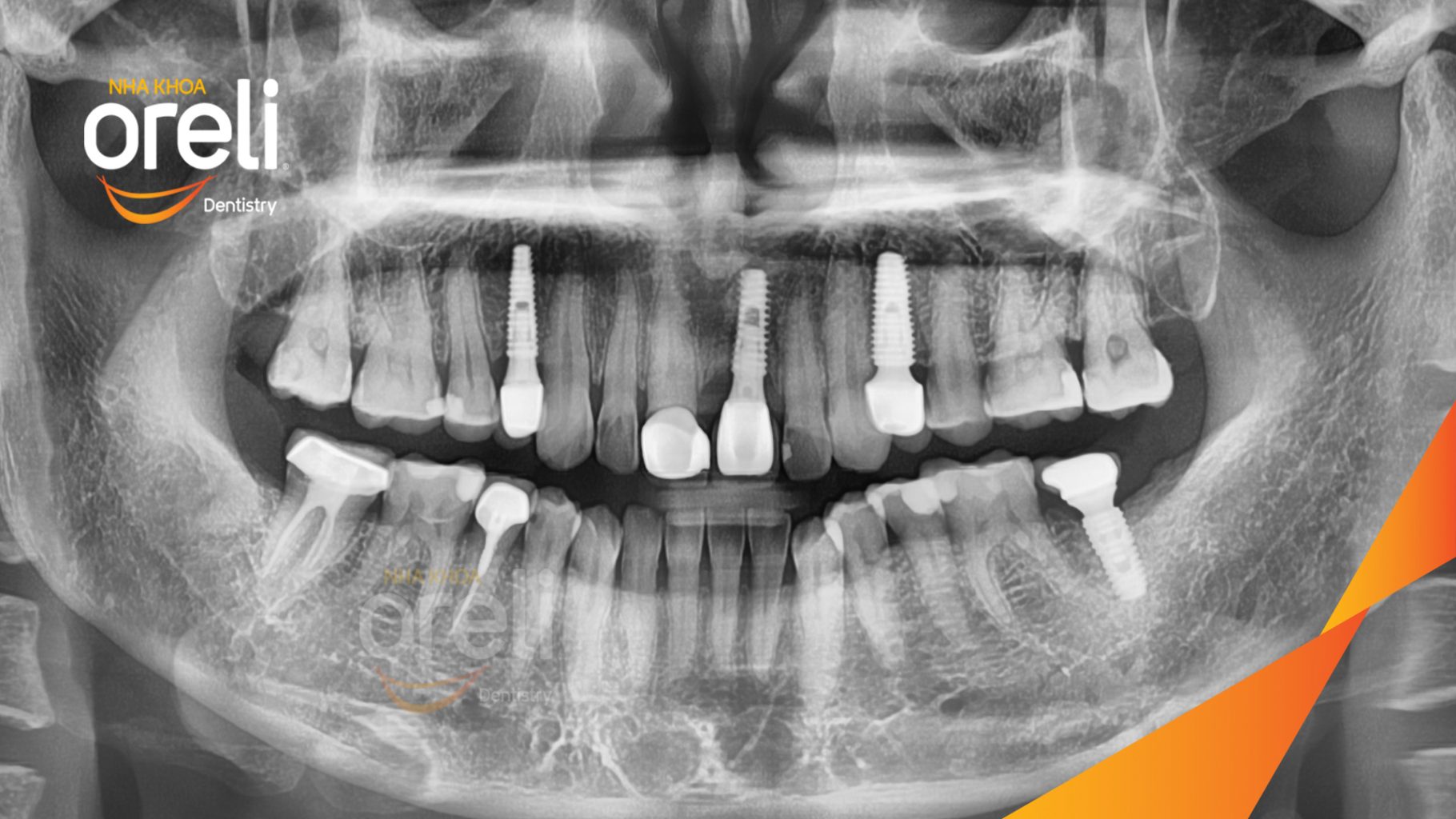 Mất răng hàm trên và dưới trước khi điều trị tại Oreli