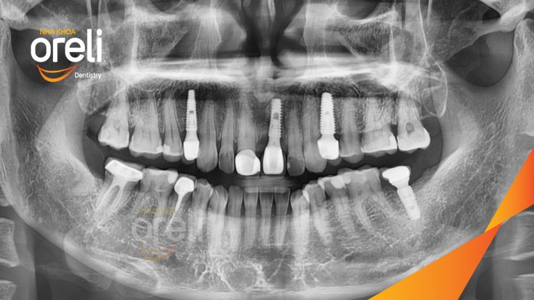 Ca Cấy Ghép Implant Hàm Dưới – Case thực tế tại Oreli