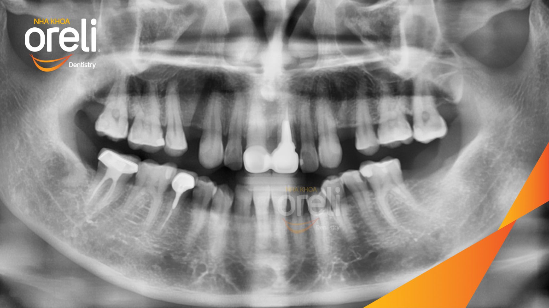 Trước điều trị: Mất răng hàm trên và dưới tại Oreli