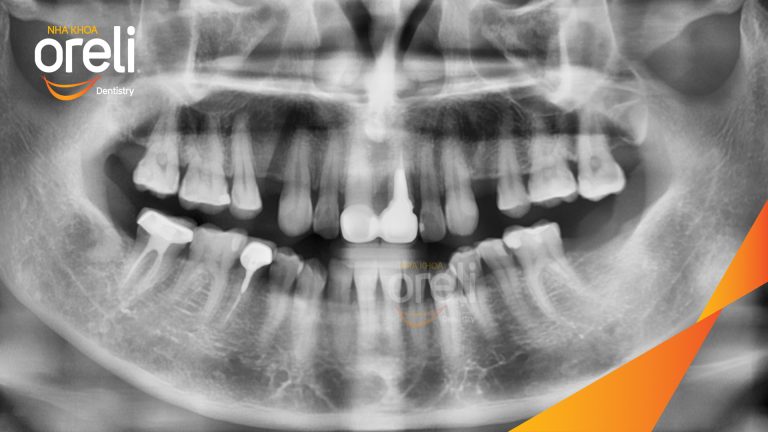 Ca Cấy Ghép Implant Hàm Dưới – Case thực tế tại Oreli