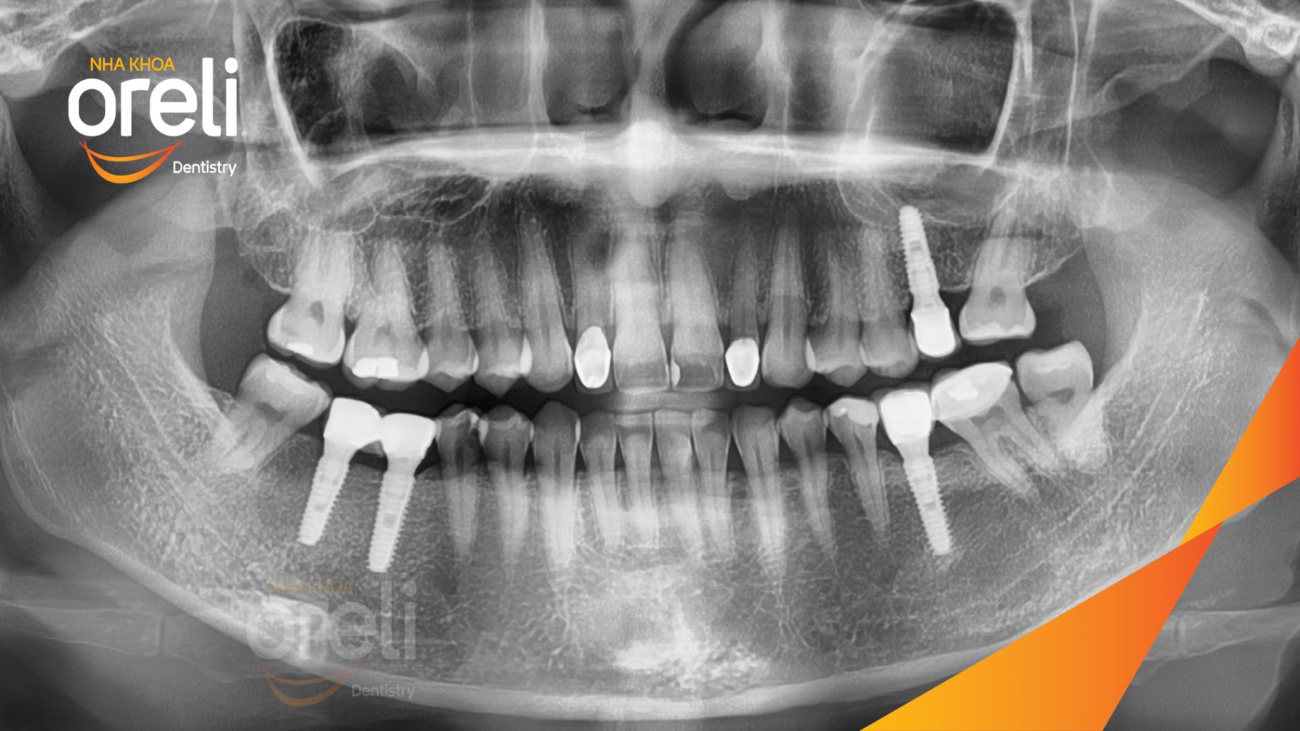 Quá trình Cấy ghép trụ Implant chính hãng vào vùng mất răng trong 3 tháng tại Oreli