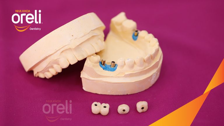 Ca Cấy Ghép Implant Hàm Dưới – Case thực tế tại Oreli