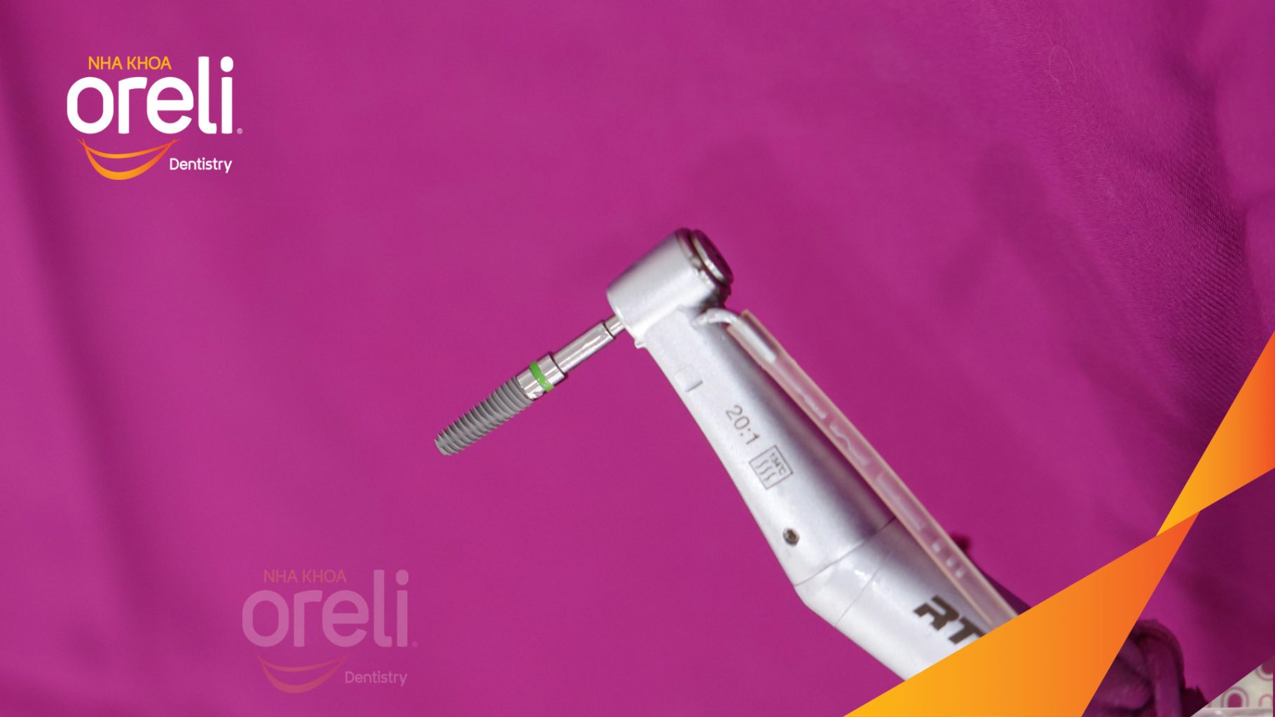 Kết quả sau 3 tháng: Hoàn thành đặt trụ Implant đúng vị trí mất răng tại Oreli