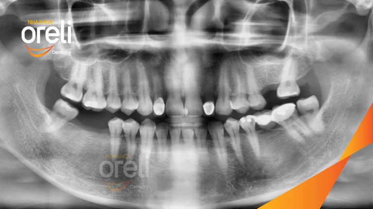 Ca Cấy Ghép Implant Hàm Dưới – Case thực tế tại Oreli