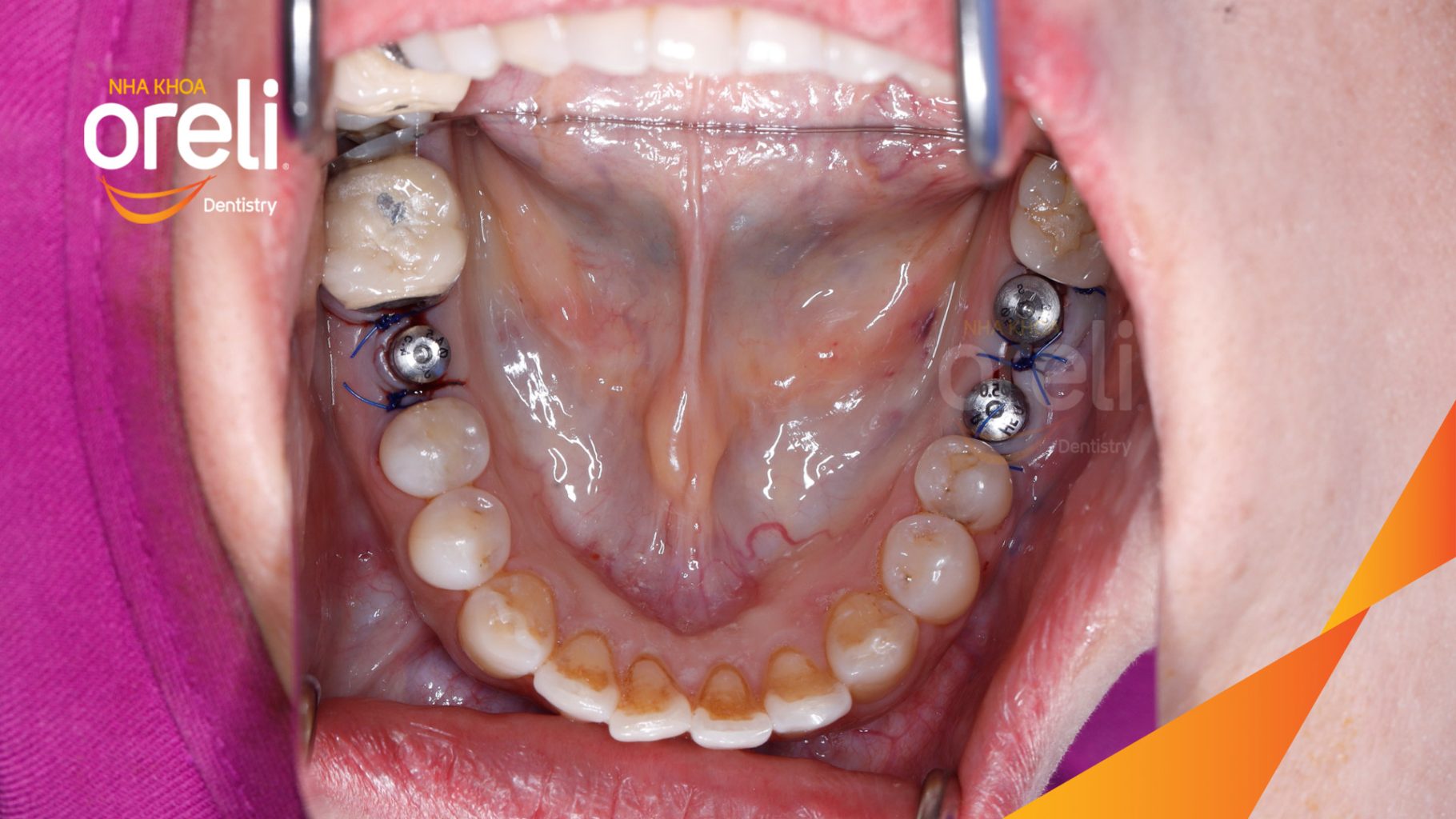 Thực hiện Cấy ghép trụ Implant chính hãng vào vùng mất răng kéo dài 3 tháng tại Oreli