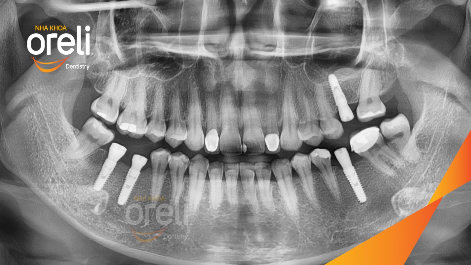 Mất răng hàm trên và dưới trước khi điều trị tại Oreli