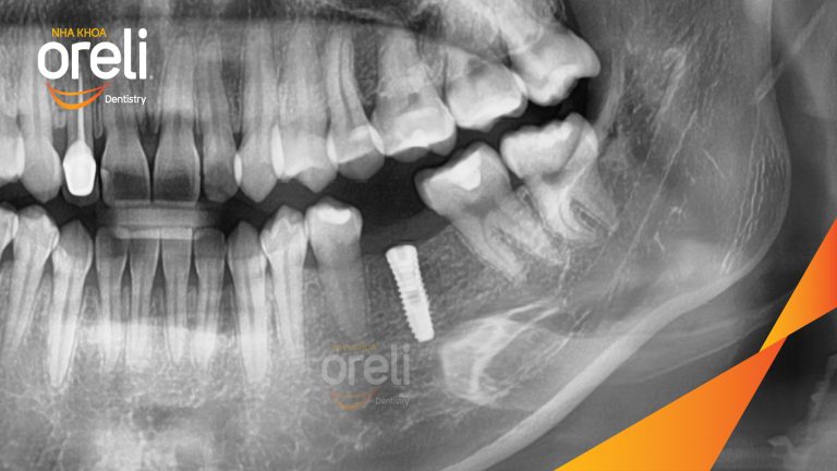 Ca Cấy Ghép Implant Phục Hồi Răng Mất Tại Nha Khoa Oreli