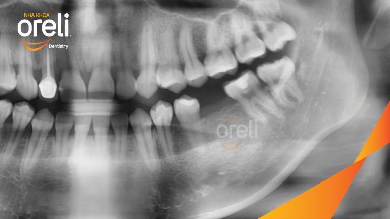Ca Cấy Ghép Implant Phục Hồi Răng Mất Tại Nha Khoa Oreli