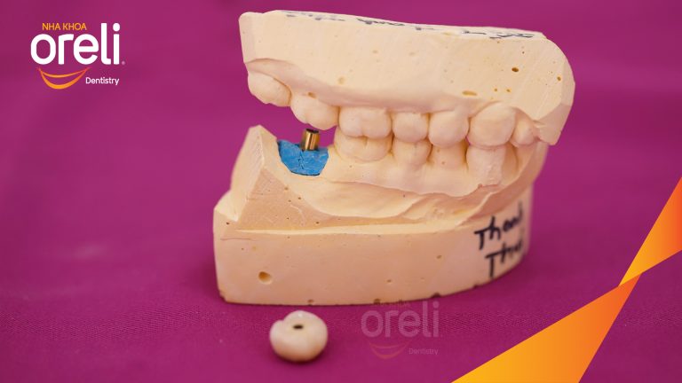 Ca Cấy Ghép Implant Phục Hồi Răng Tại Nha Khoa Oreli