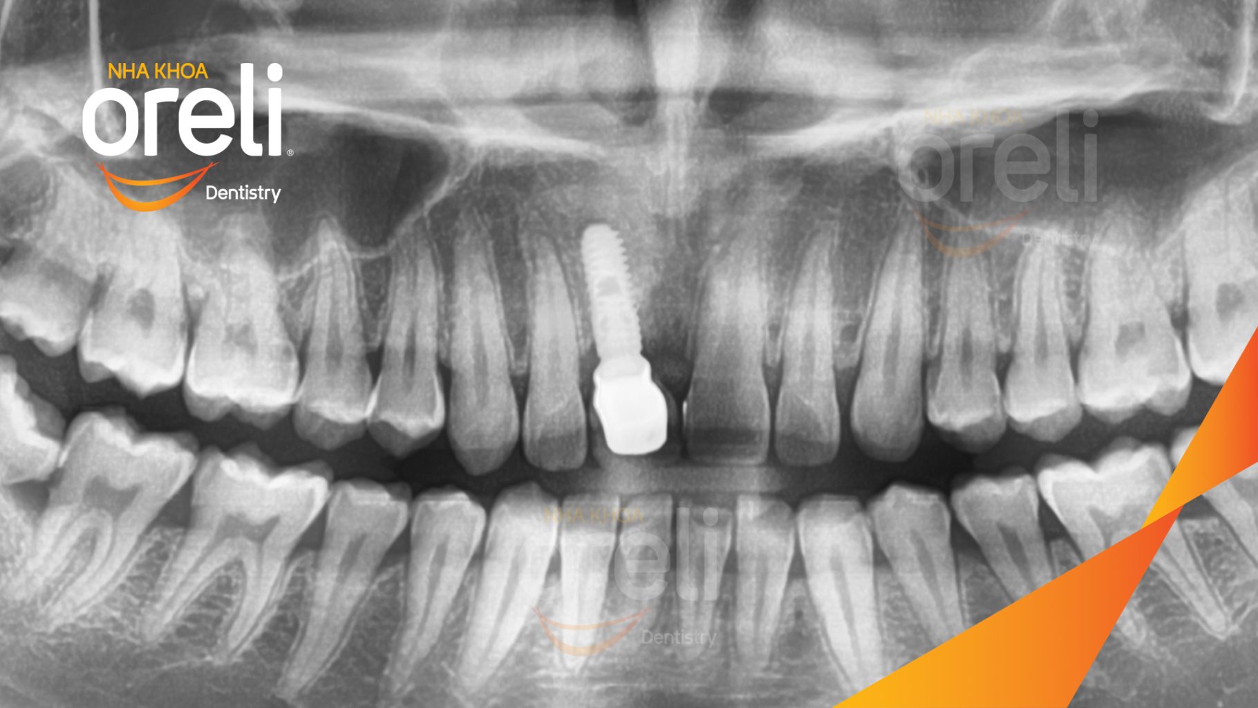Quá trình Cấy ghép trụ Implant chính hãng vào vùng mất răng trong 3 tháng tại Oreli