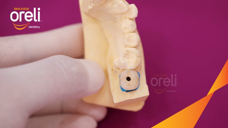 Ca Cấy Ghép Implant Phục Hồi Răng Tại Nha Khoa Oreli