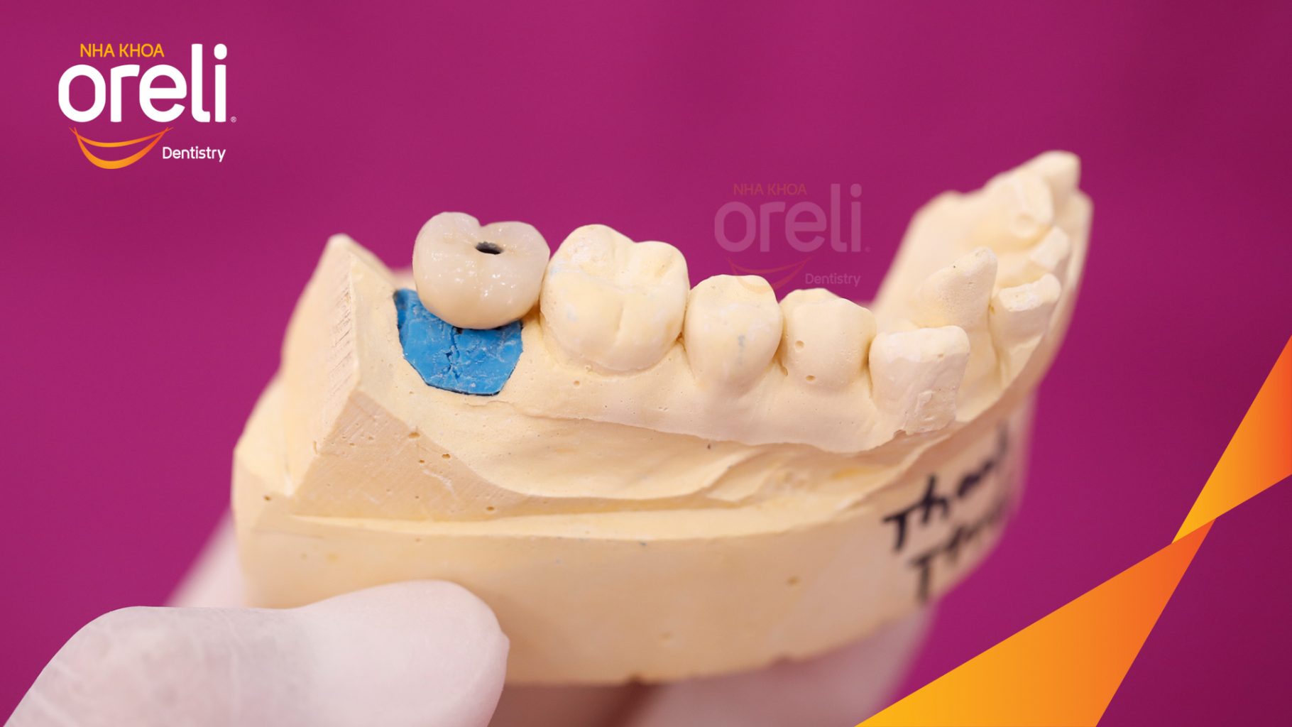 Thực hiện Cấy ghép trụ Implant chính hãng vào vùng mất răng kéo dài 3 tháng tại Oreli