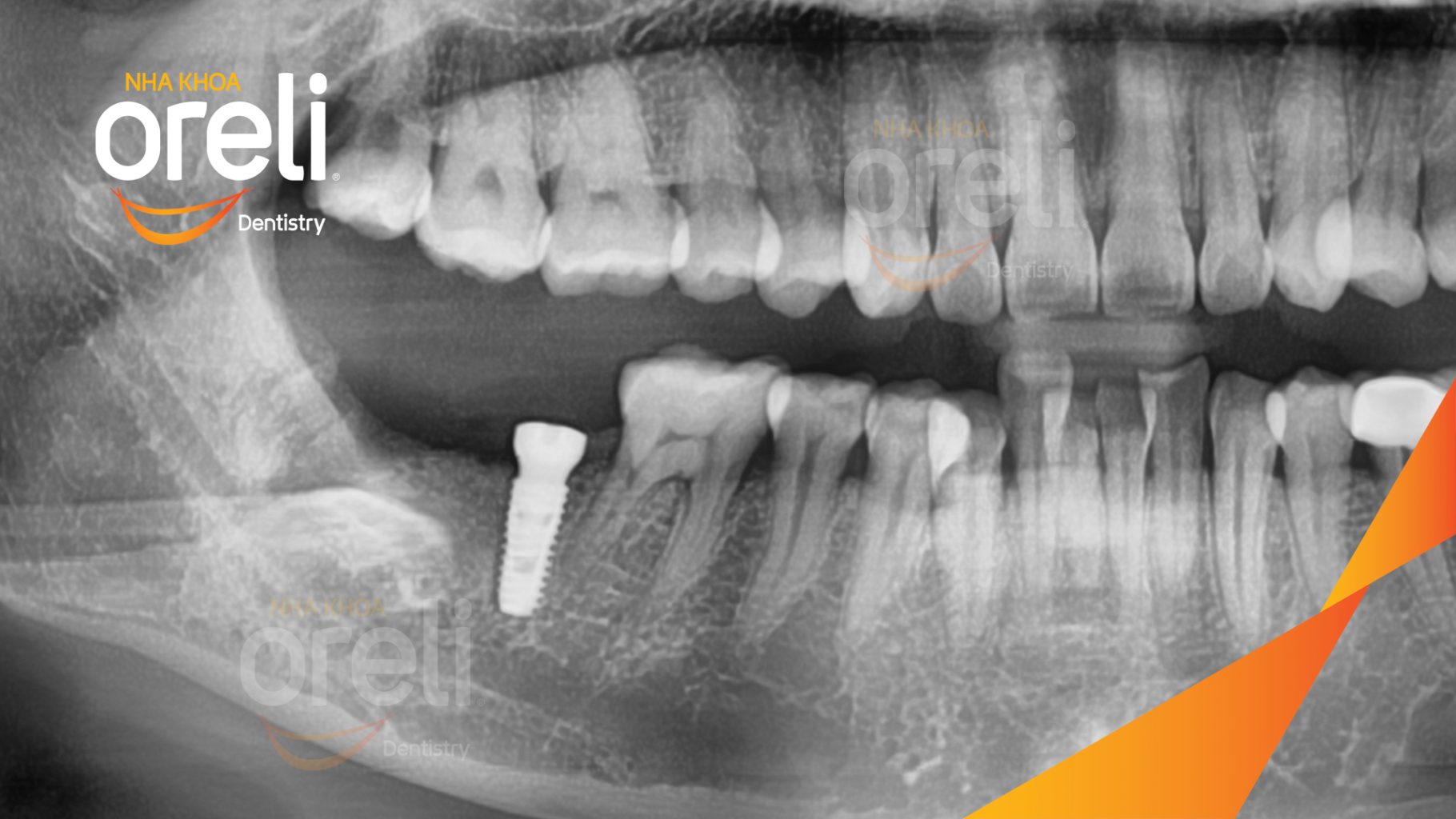 Mất răng hàm dưới thời gian dài trước khi điều trị tại Oreli