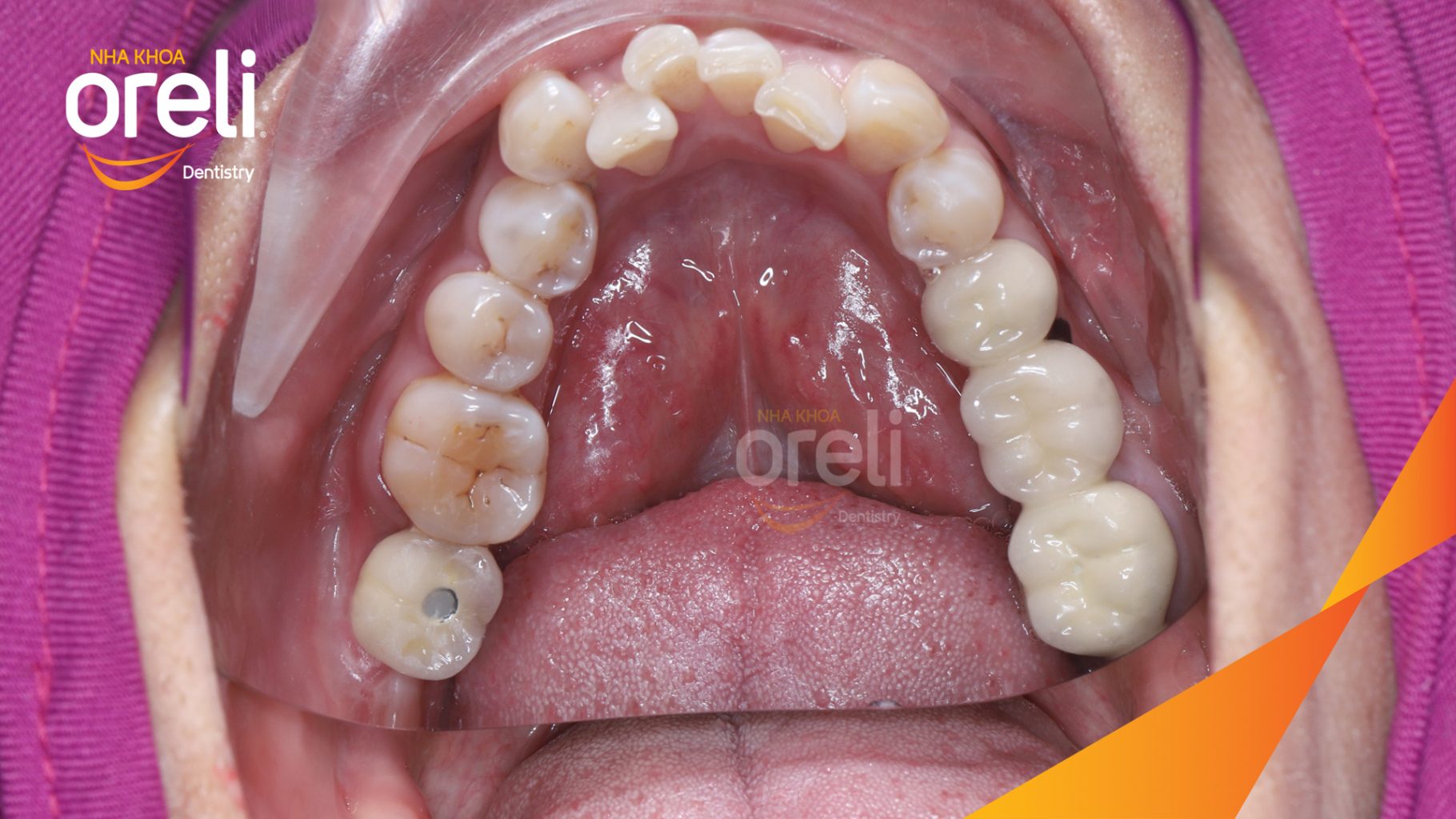 Kết quả đạt được sau 3 tháng - Phục hồi răng mất - ăn nhai chắc chắn và cười nói tự tin tại Oreli