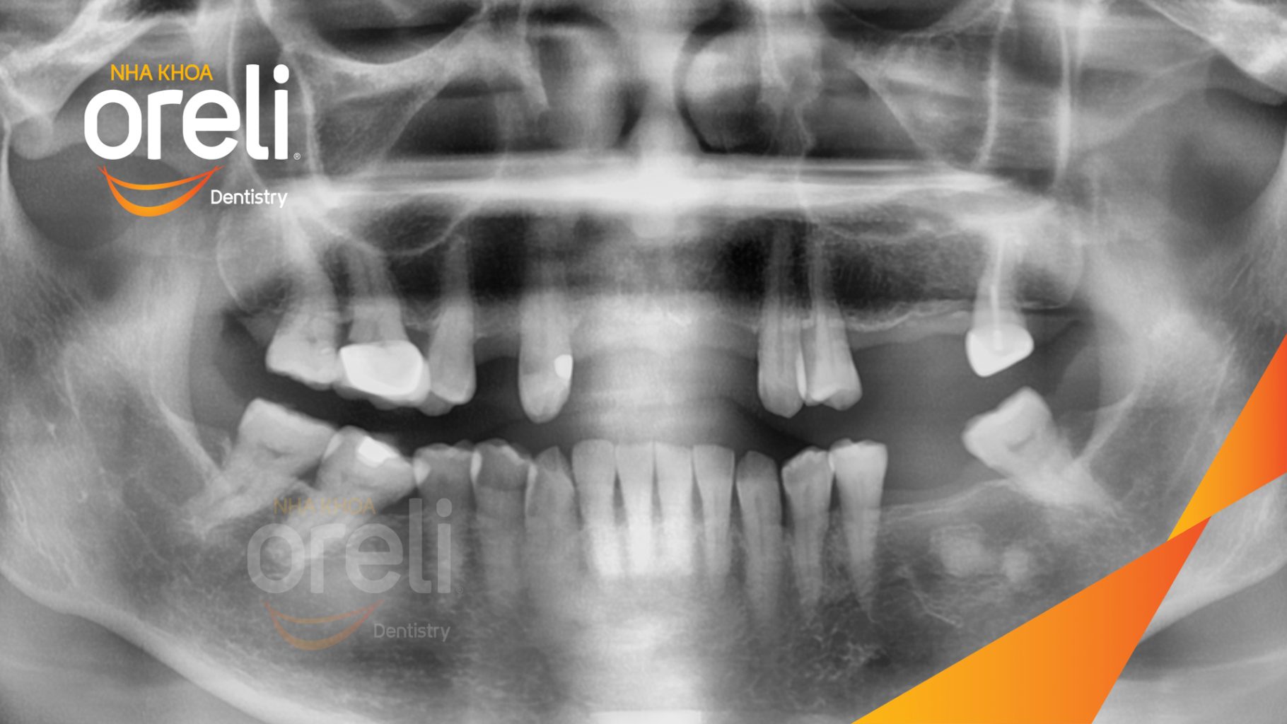 Trước điều trị: Mất nhiều răng hàm trên và dưới tại Oreli