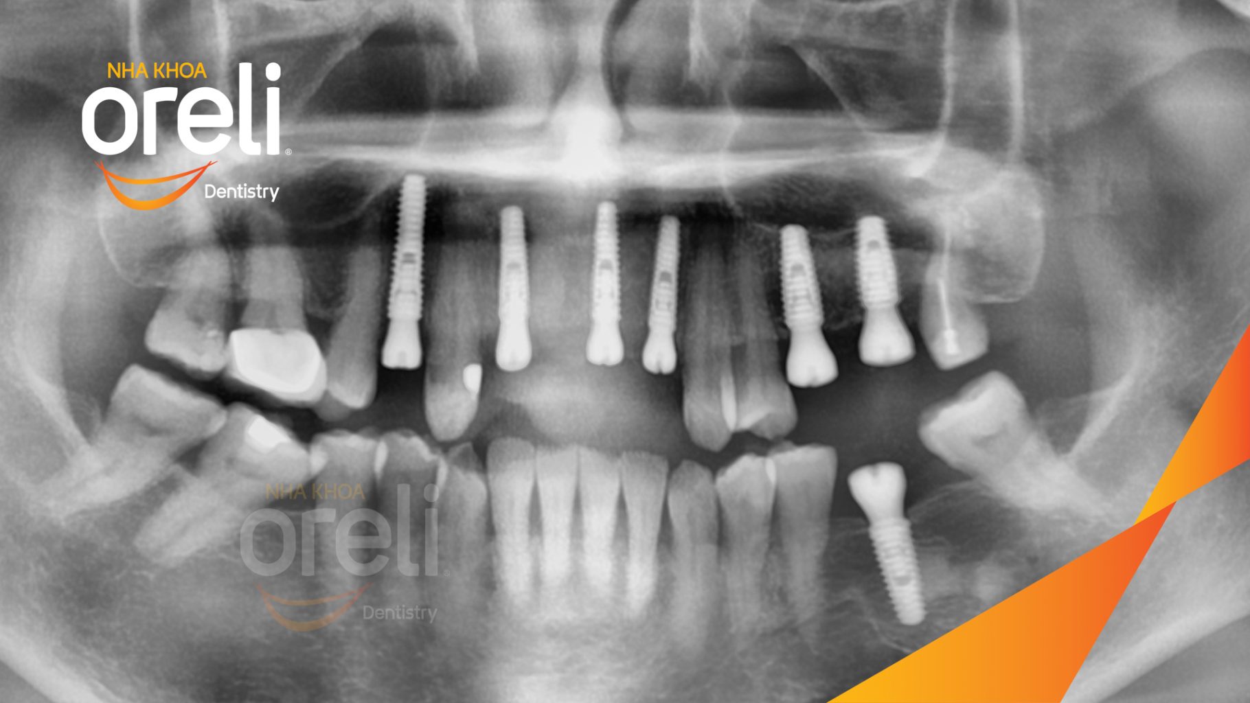 Mất nhiều răng hàm trên và dưới trước khi điều trị tại Oreli