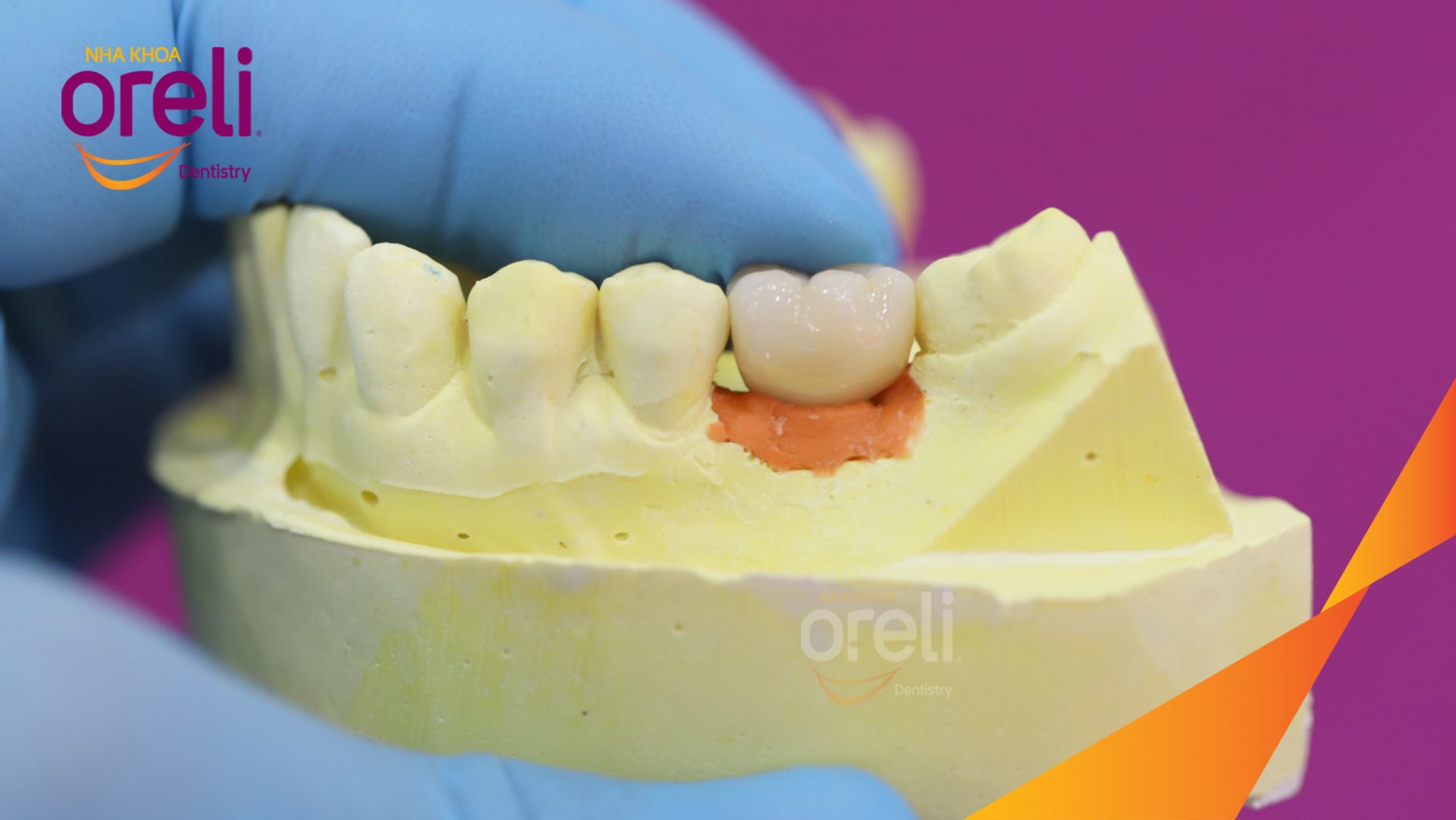 Kết quả sau 3 tháng: Phục hồi răng mất - ăn nhai chắc chắn và cười nói tự tin tại Oreli