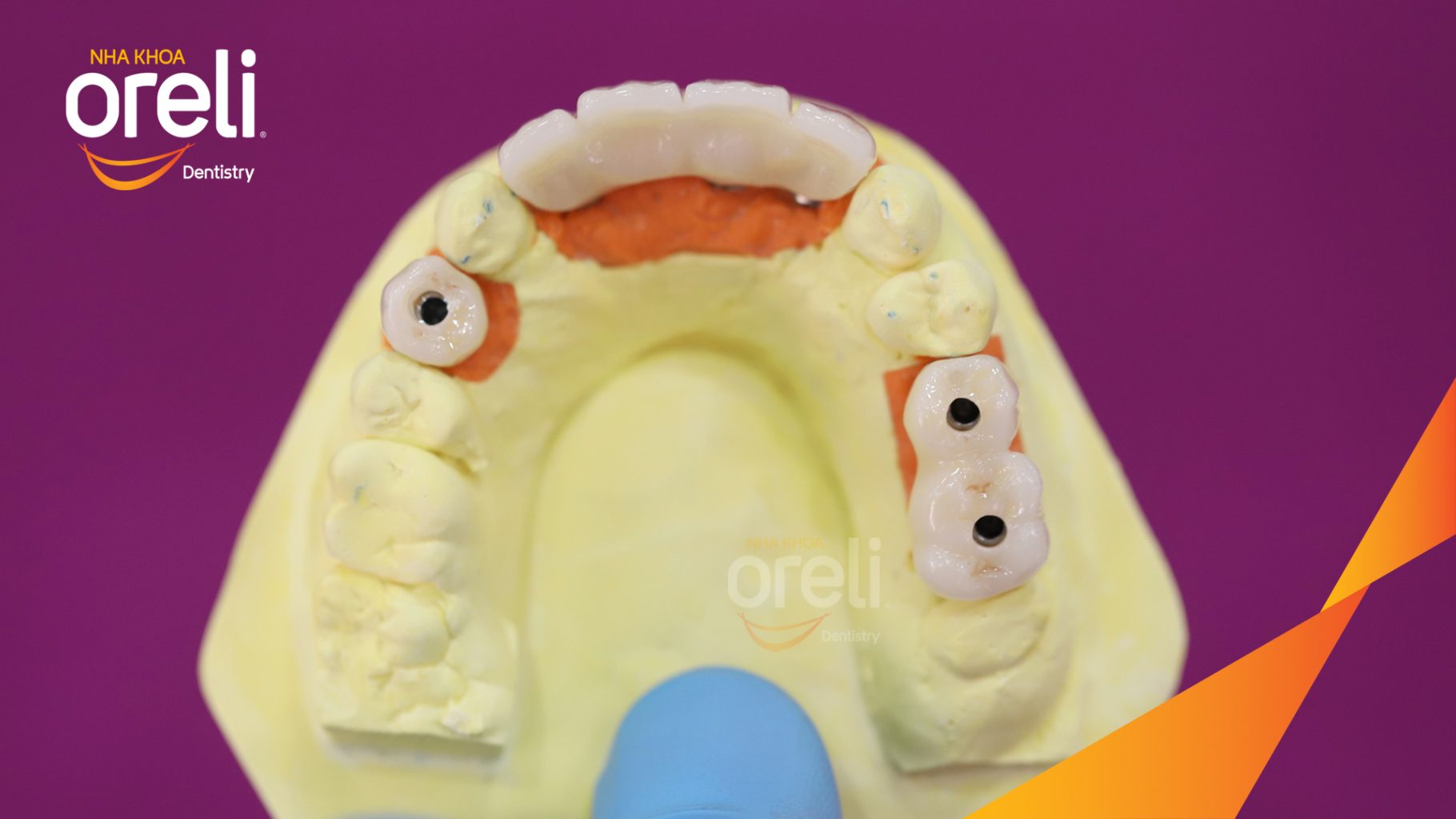 Quá trình Cấy ghép trụ Implant chính hãng vào vùng mất răng trong 3 tháng tại Oreli
