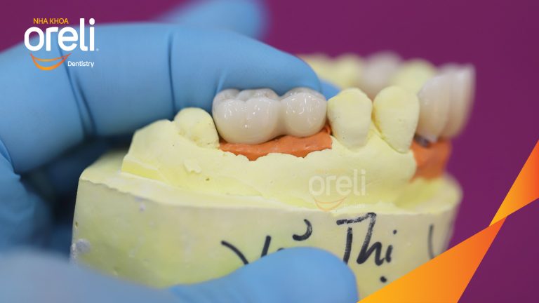 Ca Cấy Ghép Implant Phục Hồi Răng Tại Nha Khoa Oreli