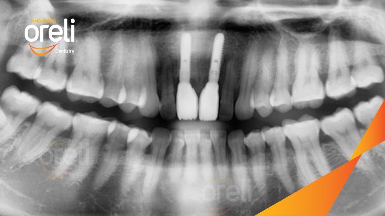 Ca Cấy Ghép Implant Phục Hồi Răng Tại Nha Khoa Oreli