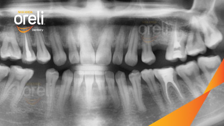 Ca Cấy Ghép Implant Phục Hồi Răng Tại Nha Khoa Oreli