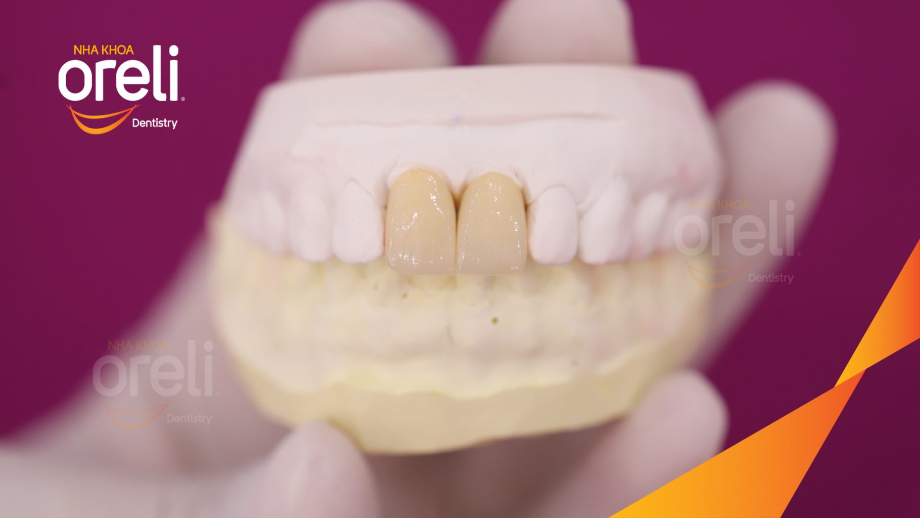 Kết quả sau 3 tháng: Phục hồi răng mất - ăn nhai chắc chắn và cười nói tự tin tại Oreli