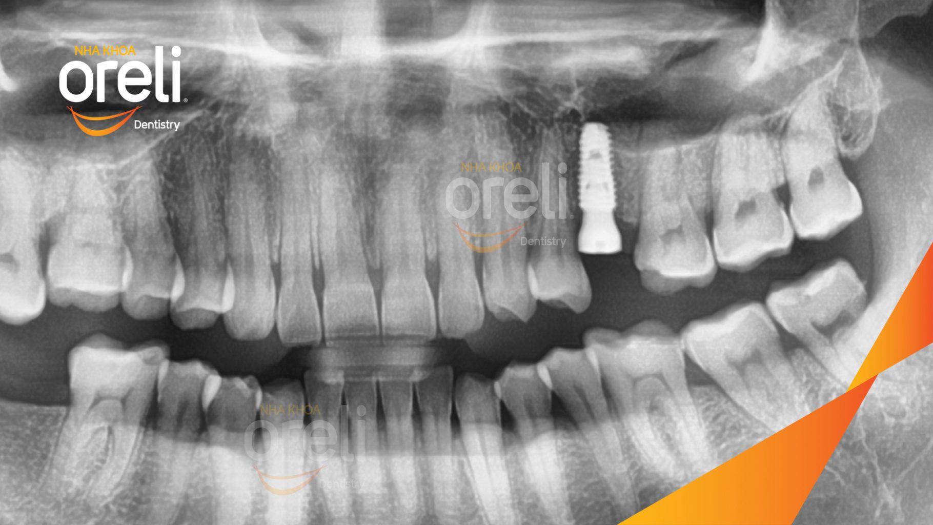 Mất răng hàm trên trước khi điều trị tại Oreli