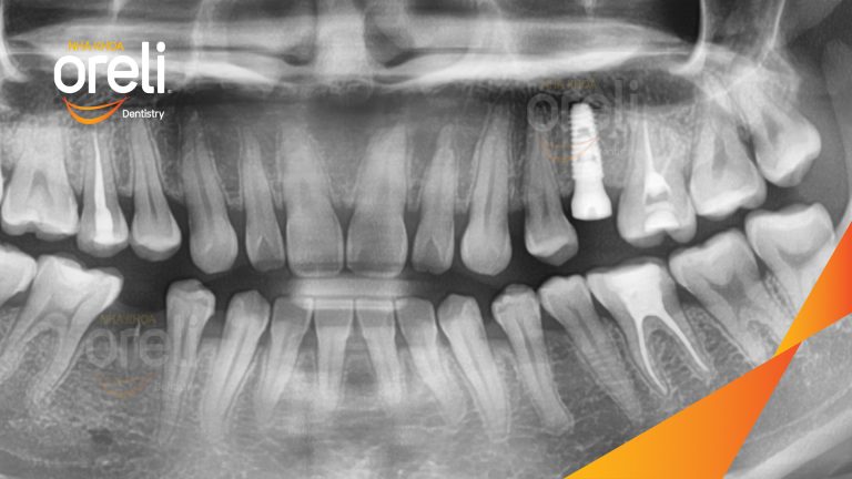 Ca Cấy Ghép Implant Phục Hồi Răng Tại Nha Khoa Oreli