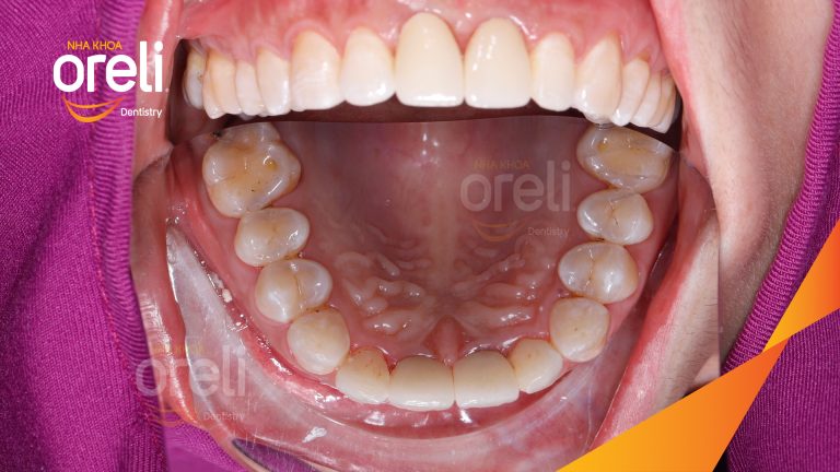 Ca Cấy Ghép Implant Phục Hồi Răng Tại Nha Khoa Oreli