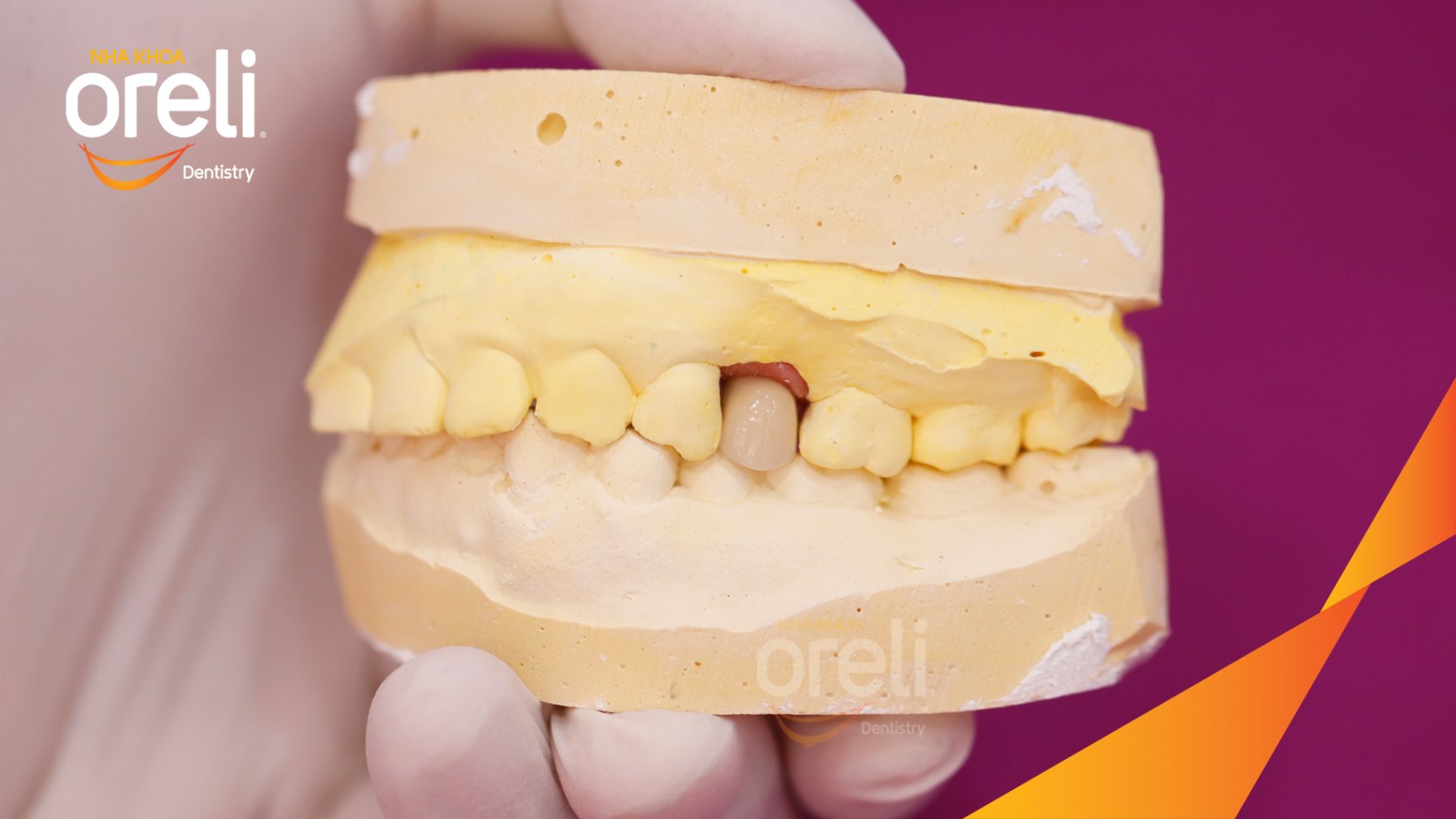 Thực hiện Cấy ghép trụ Implant chính hãng vào vùng mất răng kéo dài 3 tháng tại Oreli