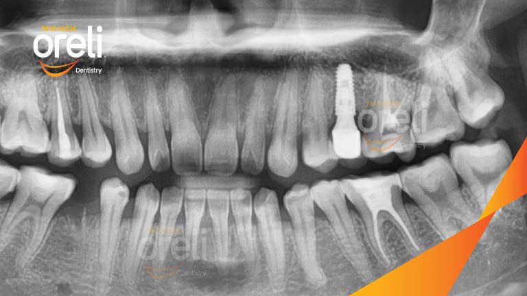 Ca Cấy Ghép Implant Phục Hồi Răng Tại Nha Khoa Oreli