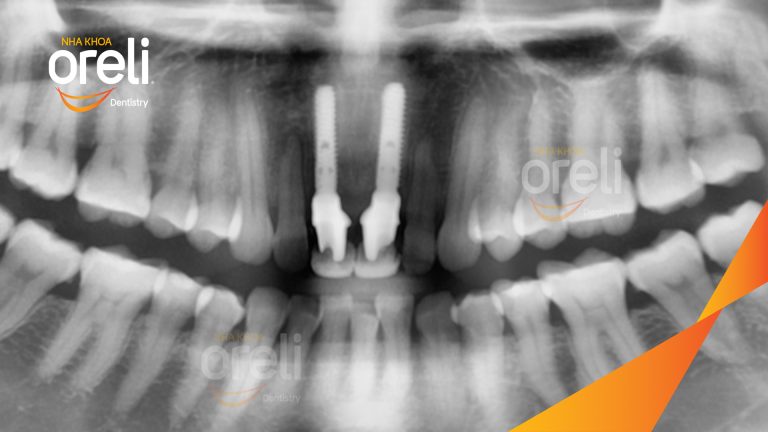 Ca Cấy Ghép Implant Phục Hồi Răng Tại Nha Khoa Oreli