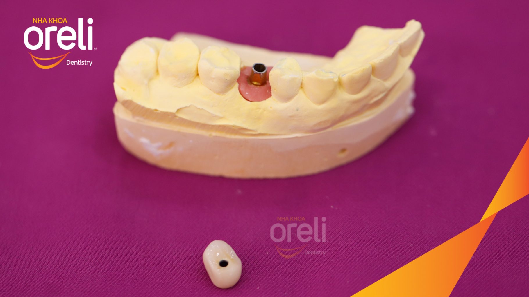 Kết quả đạt được sau 3 tháng - Phục hồi răng mất - ăn nhai chắc chắn và cười nói tự tin tại Oreli