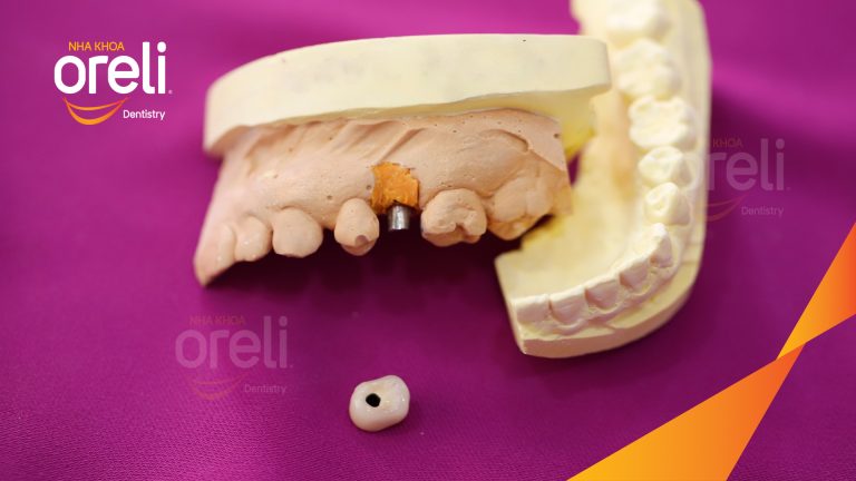 Ca Cấy Ghép Implant Phục Hồi Răng Tại Nha Khoa Oreli