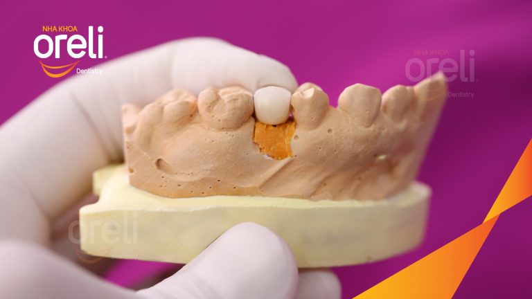 Ca Cấy Ghép Implant Phục Hồi Răng Tại Nha Khoa Oreli