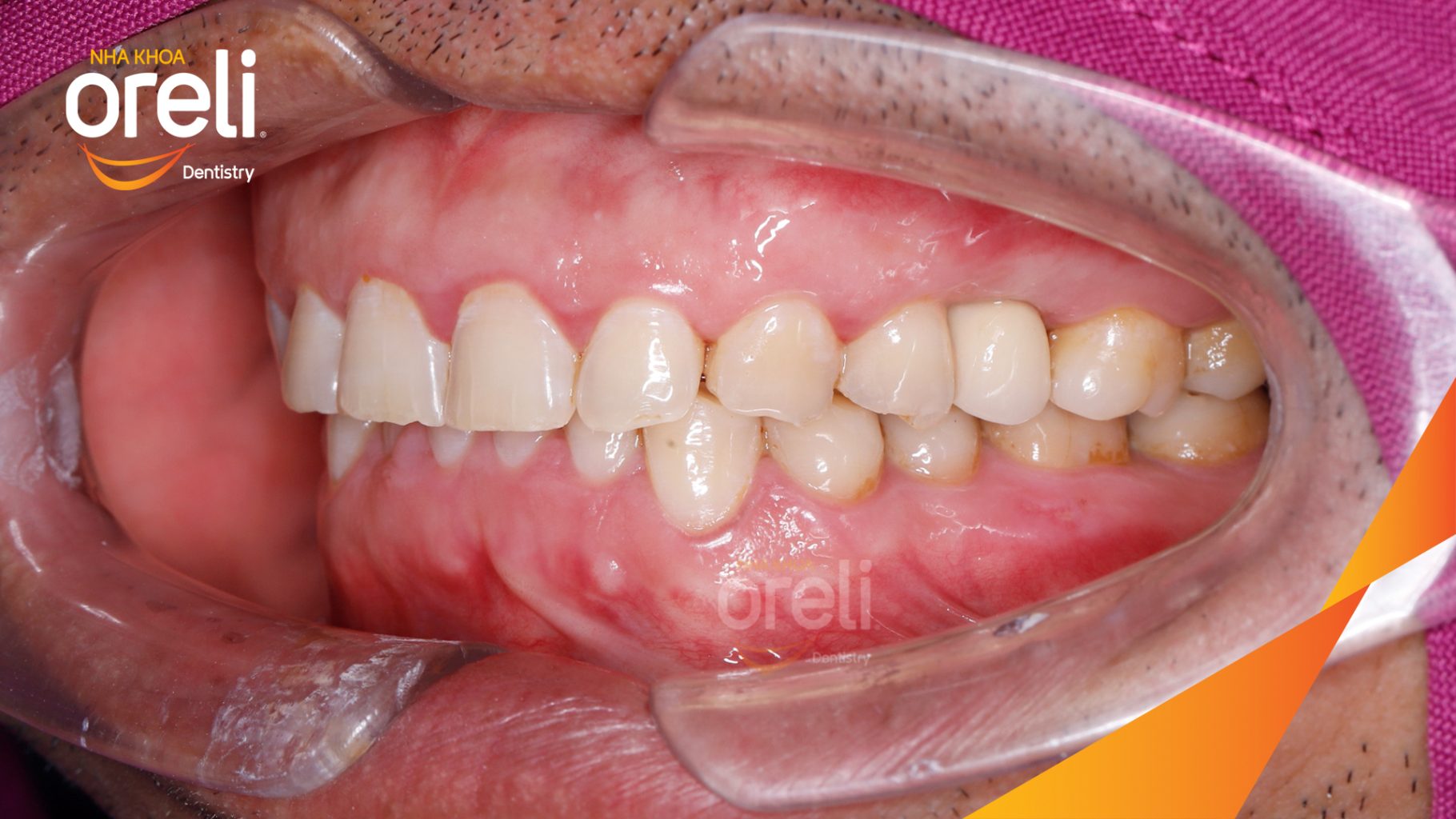Kết quả sau 3 tháng: Phục hồi răng mất - ăn nhai chắc chắn và cười nói tự tin tại Oreli