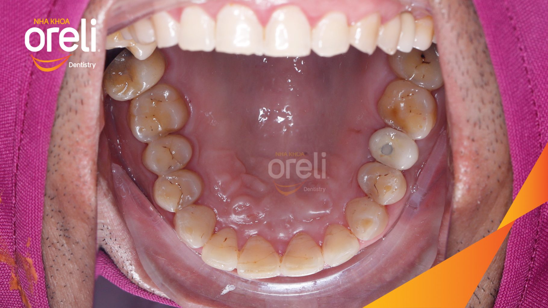 Trước điều trị: Mất răng hàm trên tại Oreli