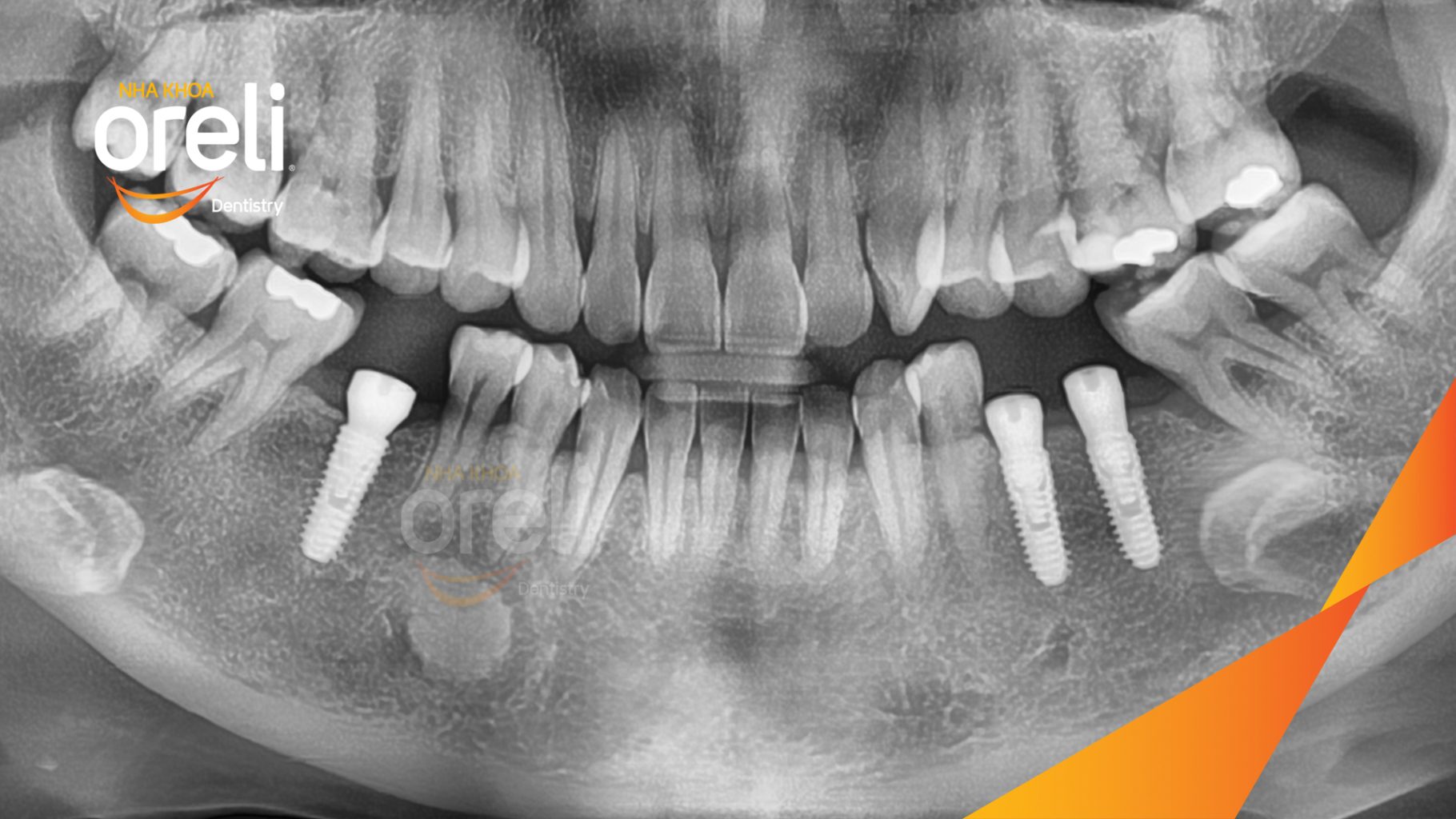 Mất răng hàm dưới trước khi điều trị tại Oreli