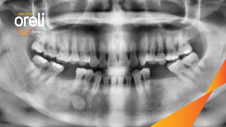 Ca Cấy Ghép Implant Hàm Dưới – Case thực tế tại Oreli
