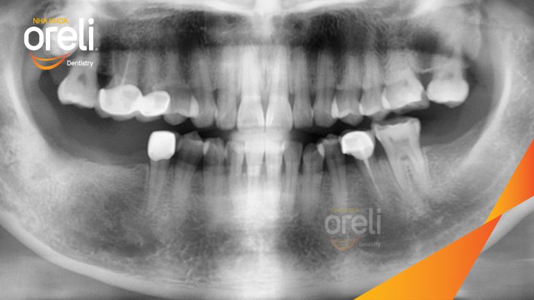 Ca Cấy Ghép Implant Hàm Dưới – Case thực tế tại Oreli