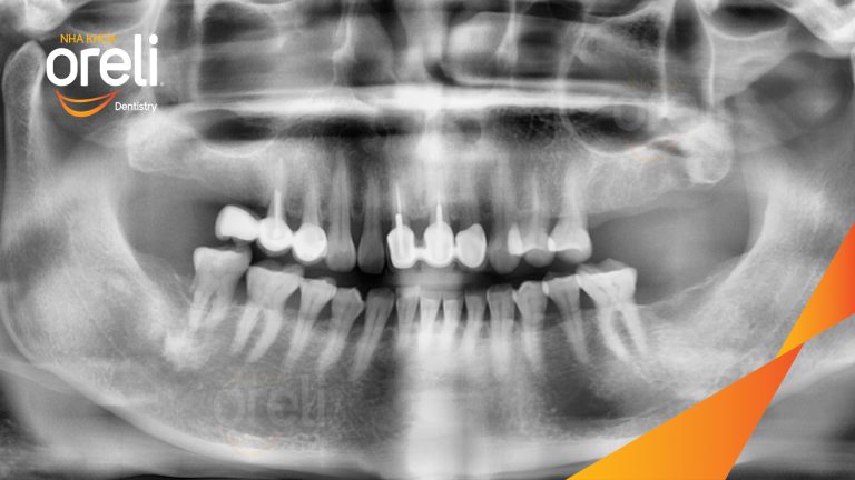 Ca Cấy Ghép Implant Hàm Dưới – Case thực tế tại Oreli