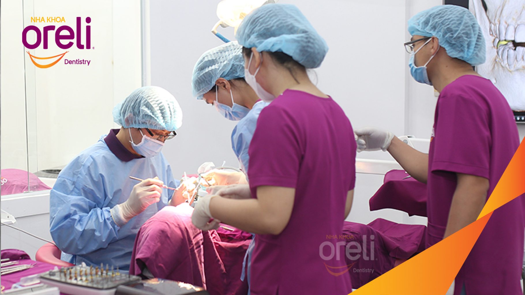 Quá trình Cấy ghép trụ Implant chính hãng vào vùng mất răng trong 3 tháng tại Oreli