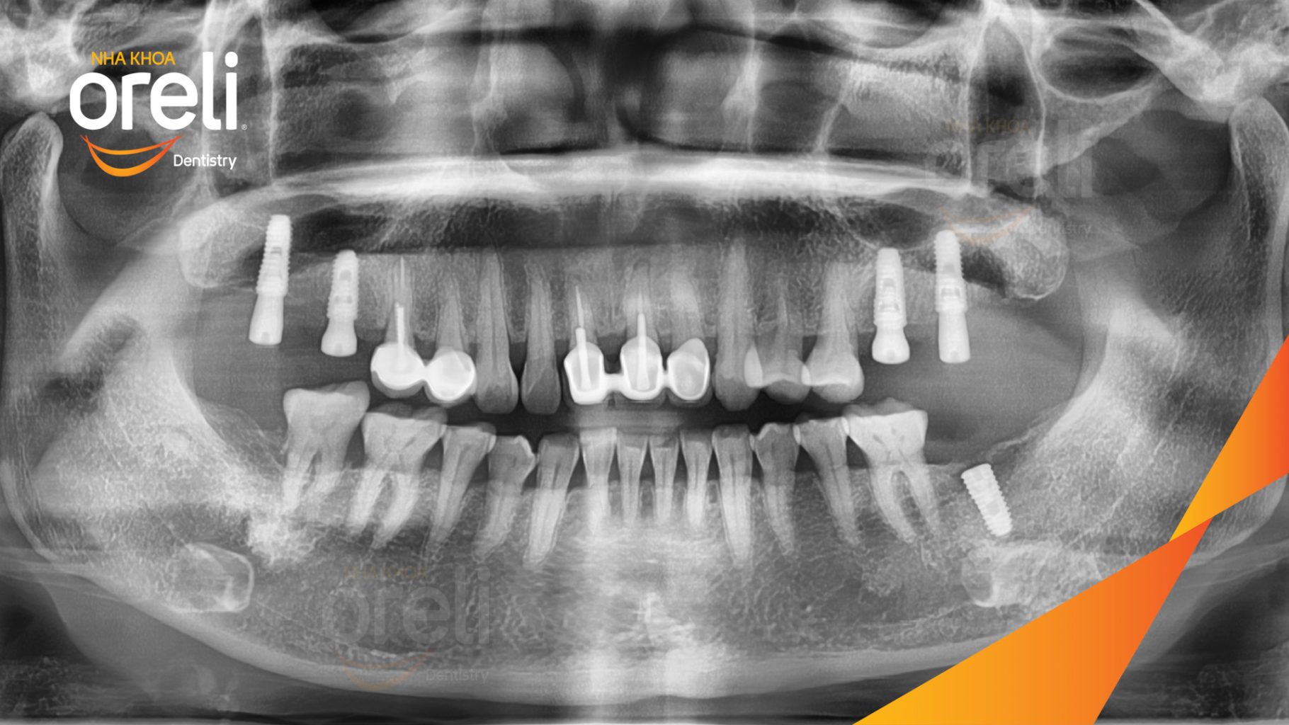 Mất răng hàm trên và dưới trước khi điều trị tại Oreli